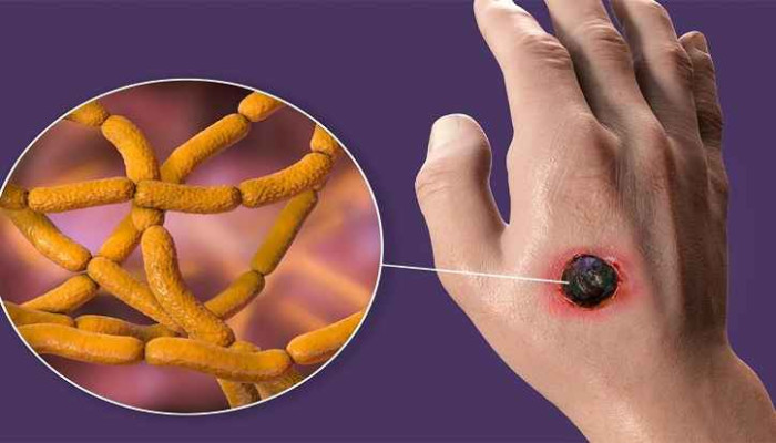 গাইবান্ধায় অ্যানথ্রাক্স রোগ প্রতিরোধে স্বাস্থ্য বিভাগের সতর্কবার্তা