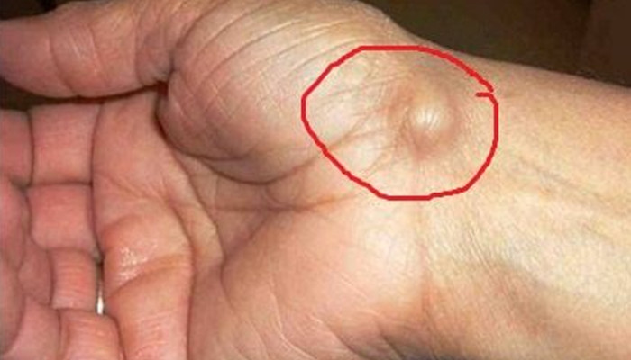 বাড়িতেই সিস্ট কমাতে কার্যকর ৫ উপায়