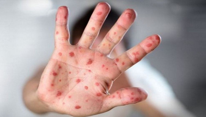 হাম হলে কী খাবেন, কী খাবেন না: দ্রুত সুস্থতায় প্রয়োজনীয় খাদ্য তালিকা