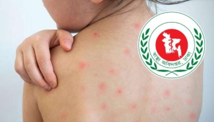 দেশে হামে ও উপসর্গে আরও ৯ শিশুর মৃত্যু, আক্রান্ত ও ভর্তি বাড়ছে