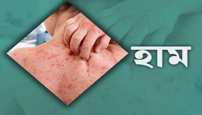 ১৮ জেলার ৩০ উপজেলায় কমছে হামের প্রকোপ, নিয়ন্ত্রণে পরিস্থিতি